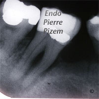 Extreme Endo Clinical Cases, Root Canal Treatment Pre-Therapy 53847-1
