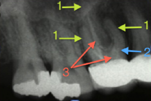 Dental Operative Microscope and Retreatment, Finding Previously Underseen MB2, Root Canal Treatment Pre-Therapy 