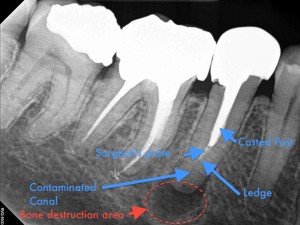 Dental operating microscope (D.O.M.), D.O.M. versus partially calcified systems, Root Canal Treatment, Post removal and endodontic revision