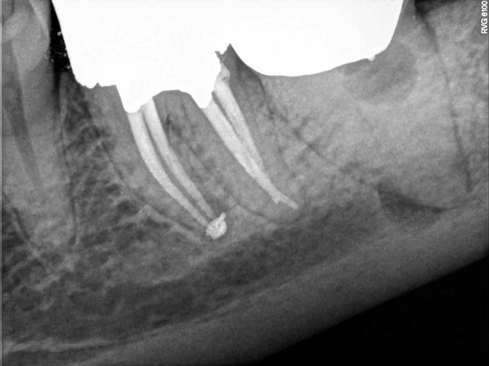 cracked root canal filling