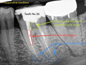 Dental Operative Microscope and Retreatment, Dealing with Broken Instruments Removal, Root Canal Treatment Pre-Therapy (2)