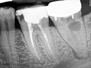 Dental Operative Microscope and Retreatment, Dealing with Broken Instruments Removal, Root Canal Treatment Pre-Therapy 