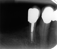 Atypical Canal Configurations, Type V, Root Canal Treatment Post-Therapy 318-3
