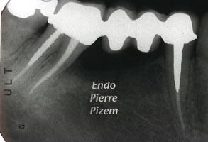 Extreme Endo Clinical Cases, Root Canal Treatment Post-Therapy 53847-2
