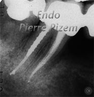 Extreme Endo Clinical Cases, Root Canal Treatment Post-Therapy 53847-1