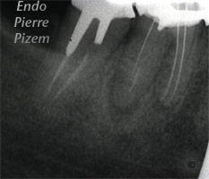 Atypical Canal Configurations, Type II, Root Canal Treatment Per-Therapy 485946-1
