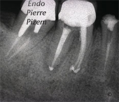 Atypical Canal Configurations, Type II, Root Canal Treatment Post-Therapy 485946-1