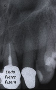 Dental operating microscope (D.O.M.), D.O.M. versus completely calcified systems, Root Canal Treatment Pre-Therapy 237122-1
