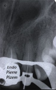 Dental operating microscope (D.O.M.), D.O.M. versus completely calcified systems, Root Canal Treatment Per-Therapy 237122-2