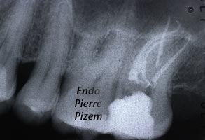 Curved Canals, Canal Curvature with an 'S' form, Root Canal Treatment Per-Therapy 449927-1