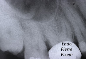 Curved Canals, Dilaceration, Root Canal Treatment Per-Therapy 498216-1