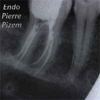 Atypical canal configurations, Radix Entomolaris, Root Canal Treatment Post-Therapy 5051-1