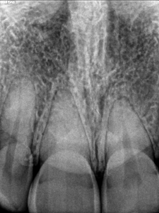 Dental operating microscope (D.O.M.), D.O.M. versus completely calcified systems, Root Canal Treatment Pre-Therapy, Calcified Tooth No 11