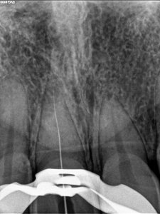 Dental operating microscope (D.O.M.), D.O.M. versus completely calcified systems, Root Canal Treatment Per-Therapy, Patency No. 6