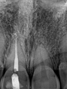 Dental operating microscope (D.O.M.), D.O.M. versus completely calcified systems, Root Canal Treatment Post-Therapy