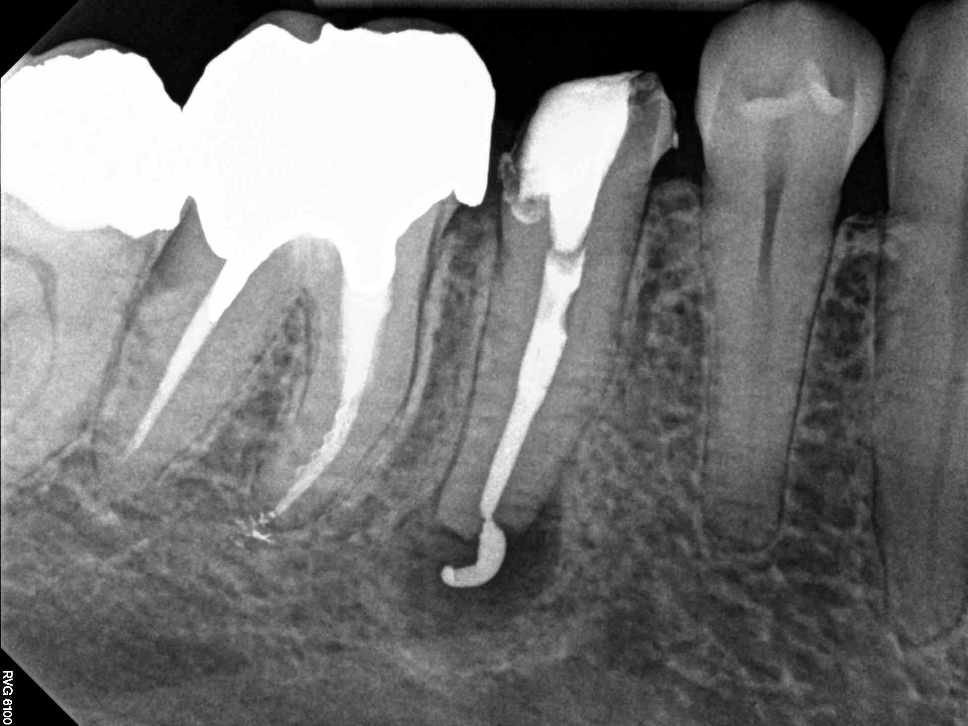 фото кости после удаления зуба