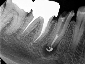 Root canal obturation