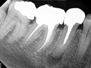 Dental operating microscope (D.O.M.), D.O.M. versus partially calcified systems, Root Canal Treatment, Endodontic Revision Procedure Tooth #45 Pre Op.