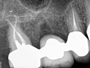 Curved Canals, Canal Curvature with an 'S' form, Root Canal Treatment, Final Restauration