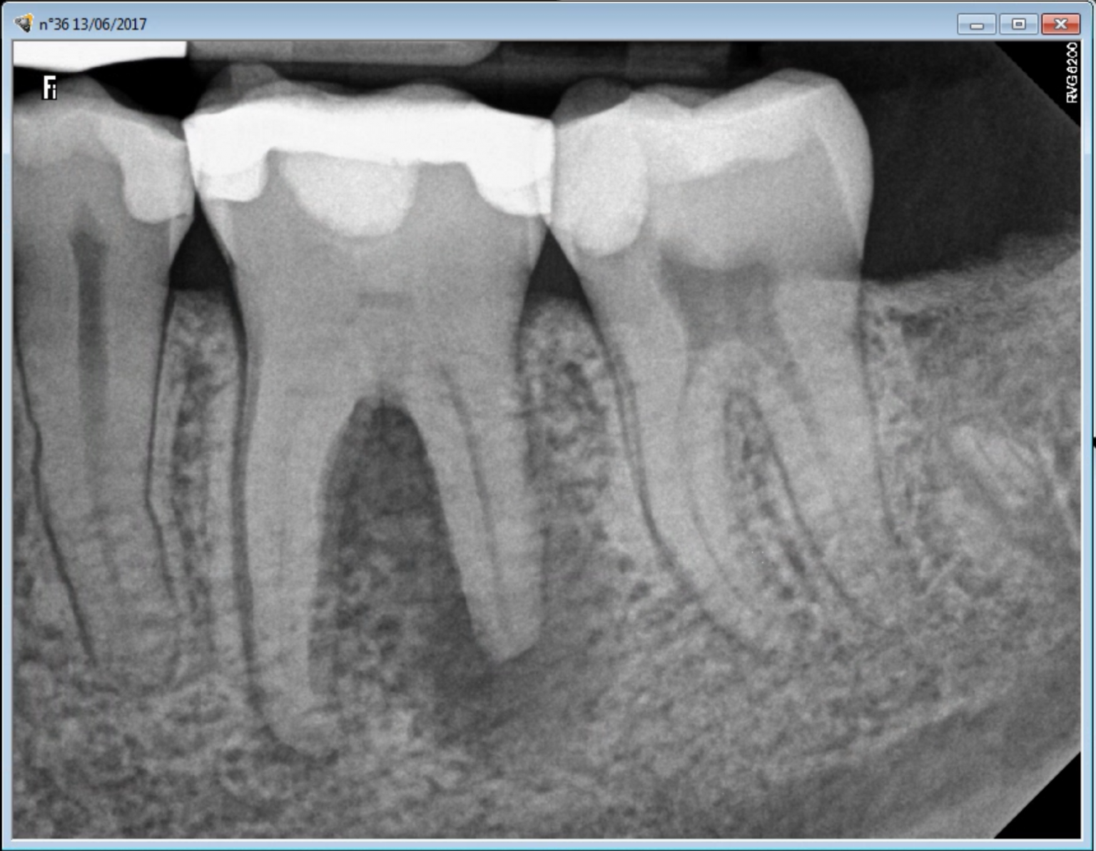 reparative dentine  ENDOMONTREAL